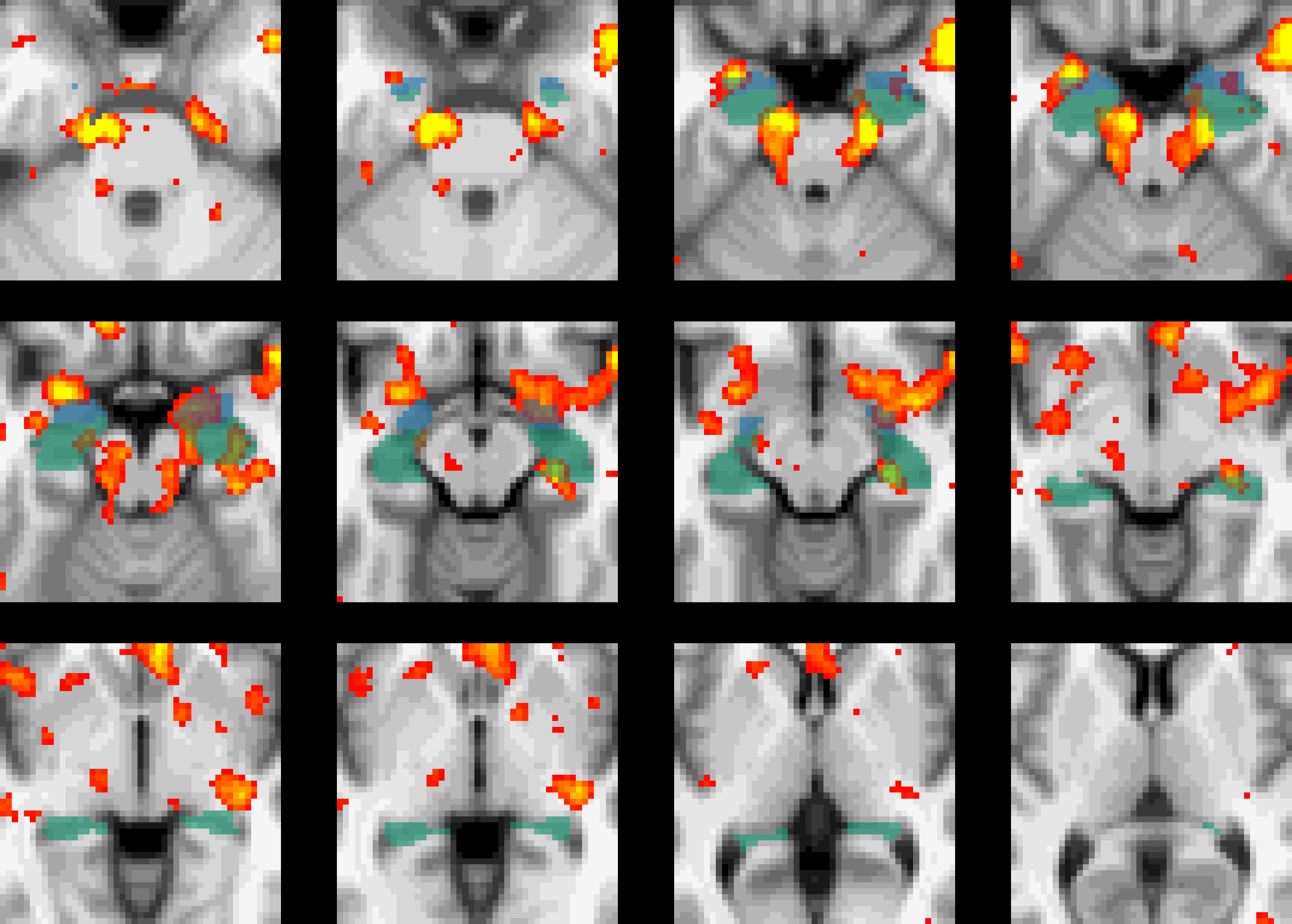 Stage 1 eTMS for PTSD increased perfusion in the Amygdala and Hippocampus